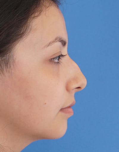 Rhinoplasty Before & After Gallery - Patient 196701 - Image 1