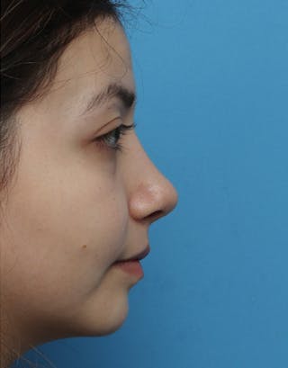Rhinoplasty Before & After Gallery - Patient 196701 - Image 2