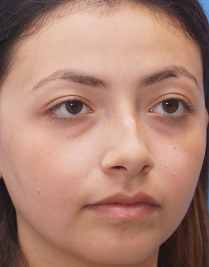 Rhinoplasty  Before & After Gallery - Patient 196701 - Image 5