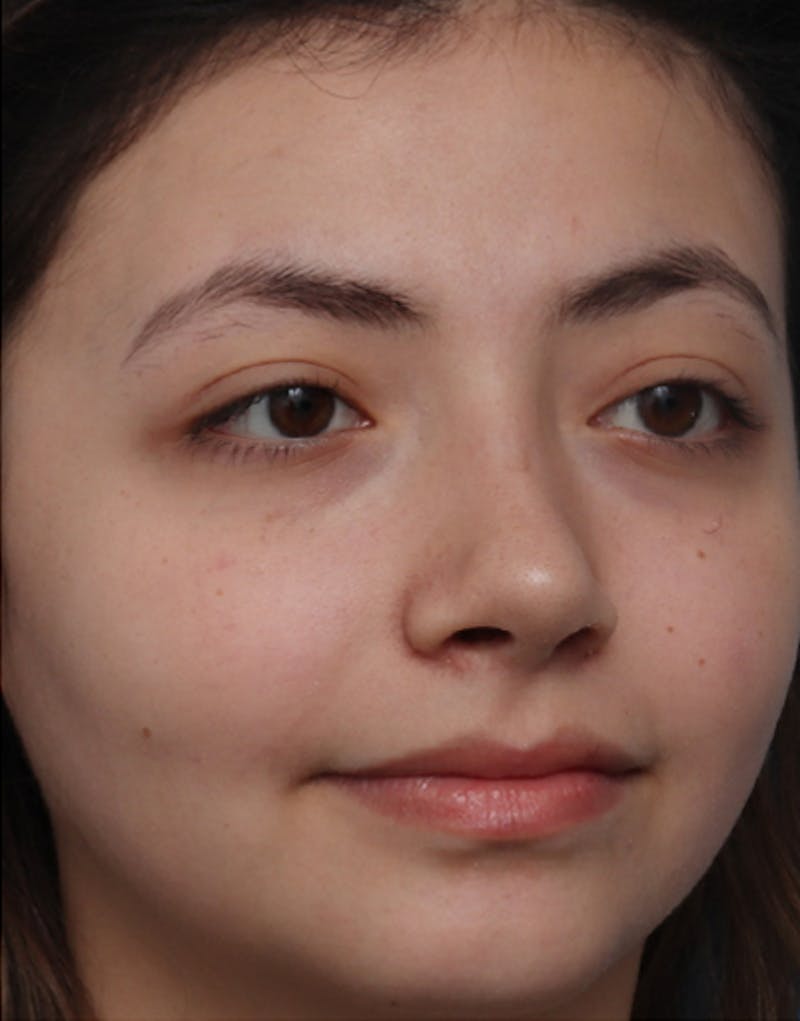 Rhinoplasty  Before & After Gallery - Patient 196701 - Image 6