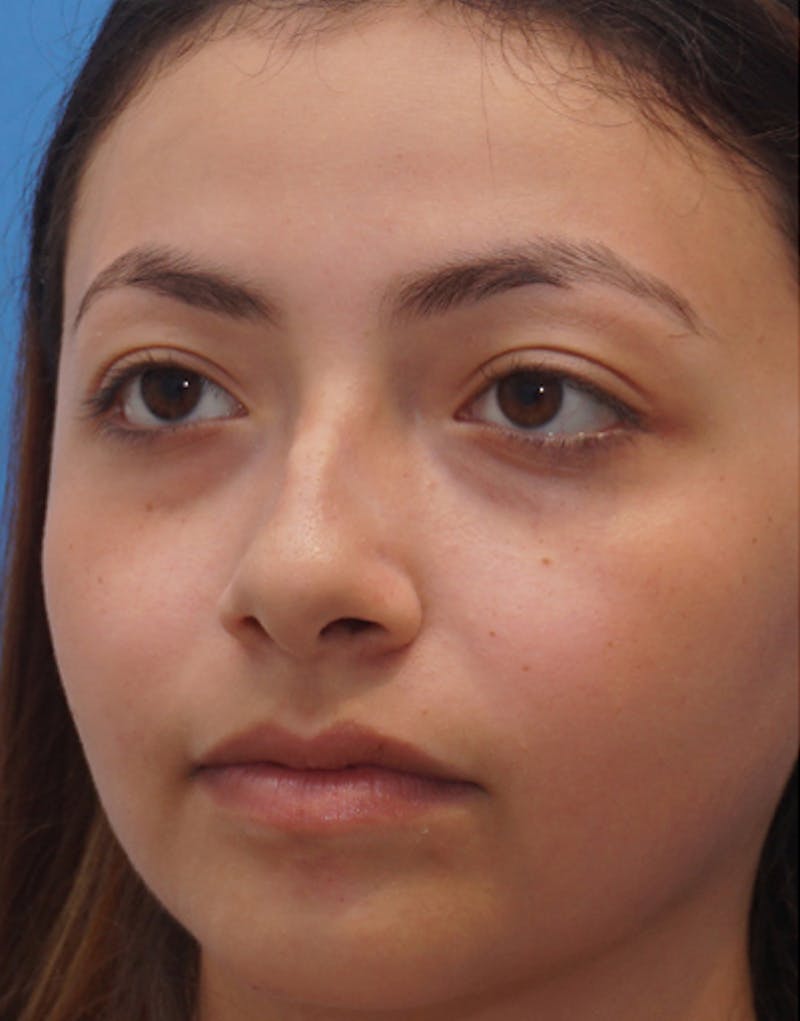 Rhinoplasty  Before & After Gallery - Patient 196701 - Image 7