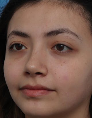 Rhinoplasty Before & After Gallery - Patient 196701 - Image 8