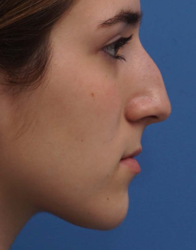 Patient Tk_2pVGYTqyiVSqRA4Kh9A - Rhinoplasty Before & After Photos