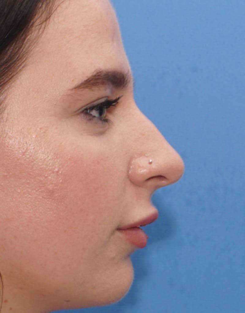 Rhinoplasty Before & After Gallery - Patient 374075 - Image 1