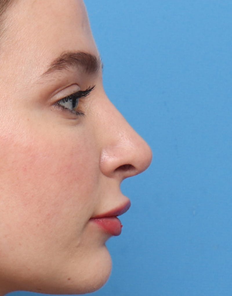 Rhinoplasty Before & After Gallery - Patient 374075 - Image 2