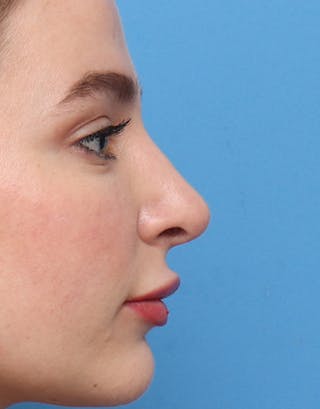 Rhinoplasty Before & After Gallery - Patient 269921 - Image 2