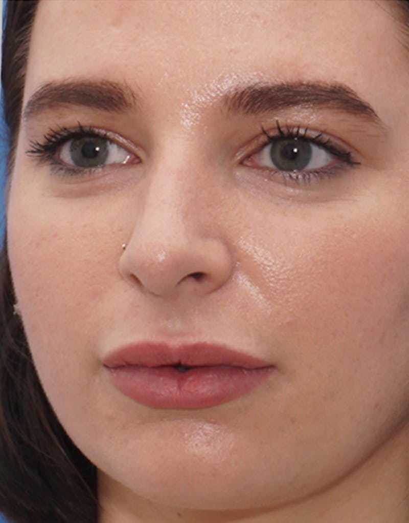 Rhinoplasty  Before & After Gallery - Patient 269921 - Image 3