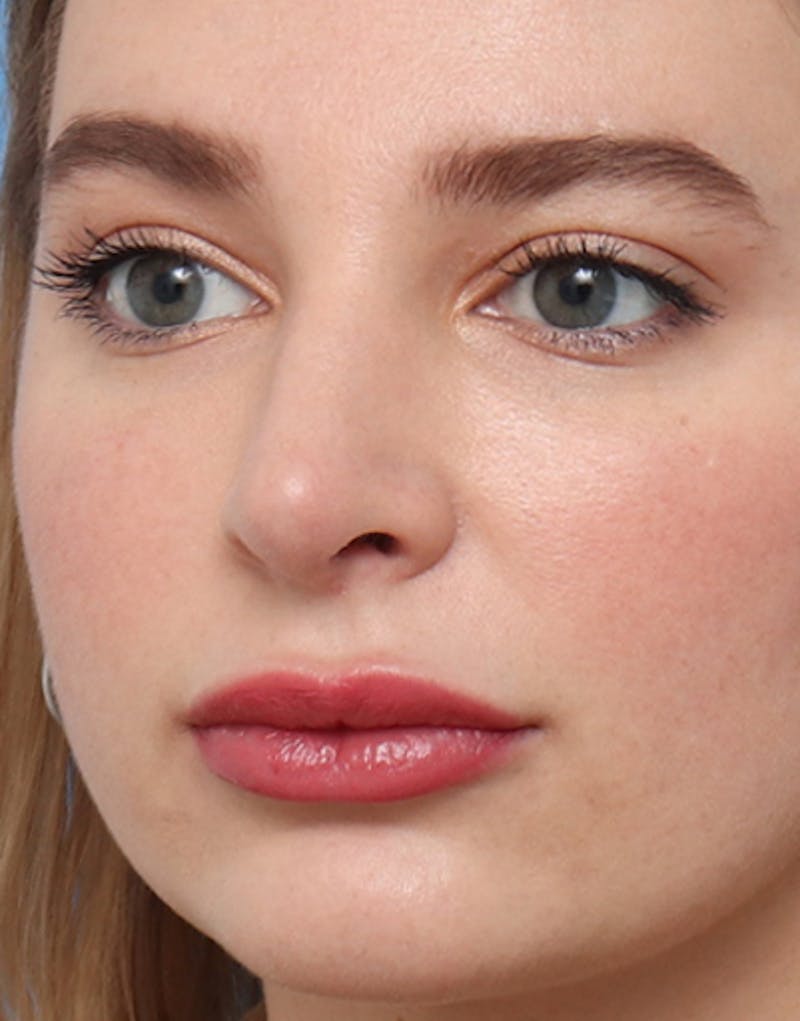 Rhinoplasty  Before & After Gallery - Patient 269921 - Image 4