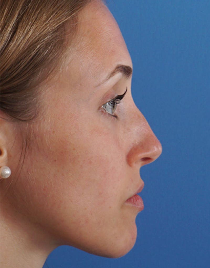 Rhinoplasty Before & After Gallery - Patient 663954 - Image 1