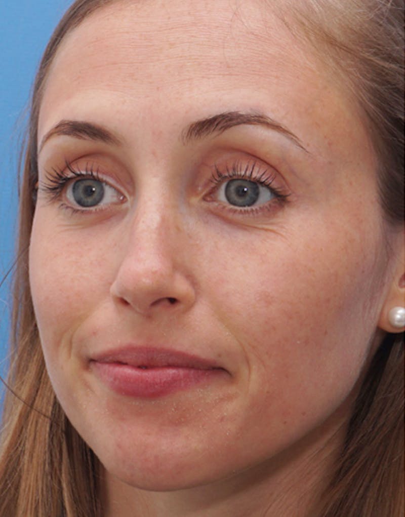 Rhinoplasty Before & After Gallery - Patient 663954 - Image 7