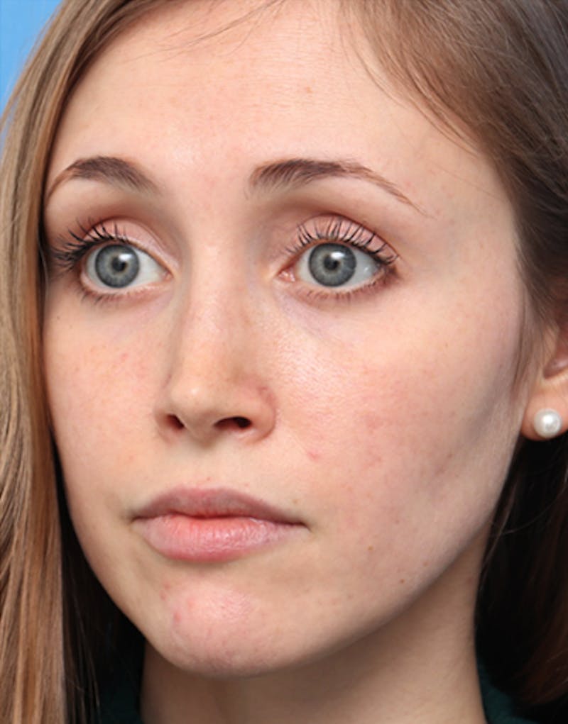 Rhinoplasty Before & After Gallery - Patient 663954 - Image 8
