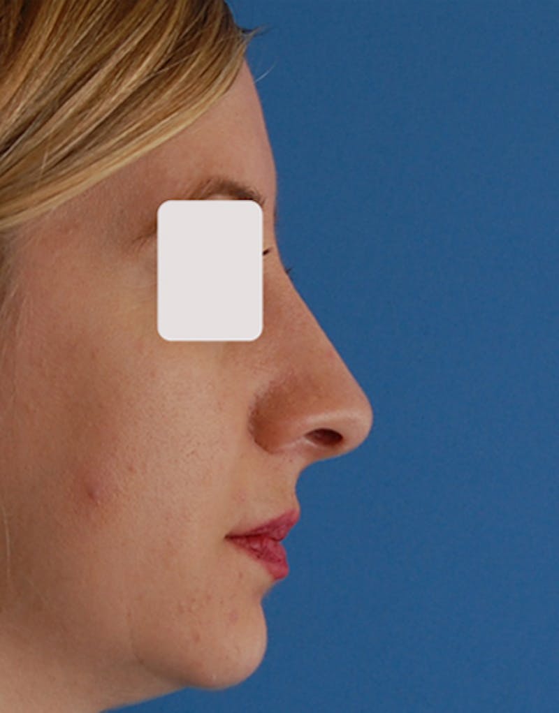 Patient Ay7HA1EmR_WjdiCkf8Y78A - Rhinoplasty Before & After Photos
