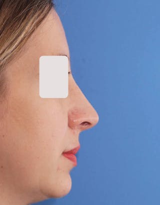 Rhinoplasty Before & After Gallery - Patient 166203 - Image 2