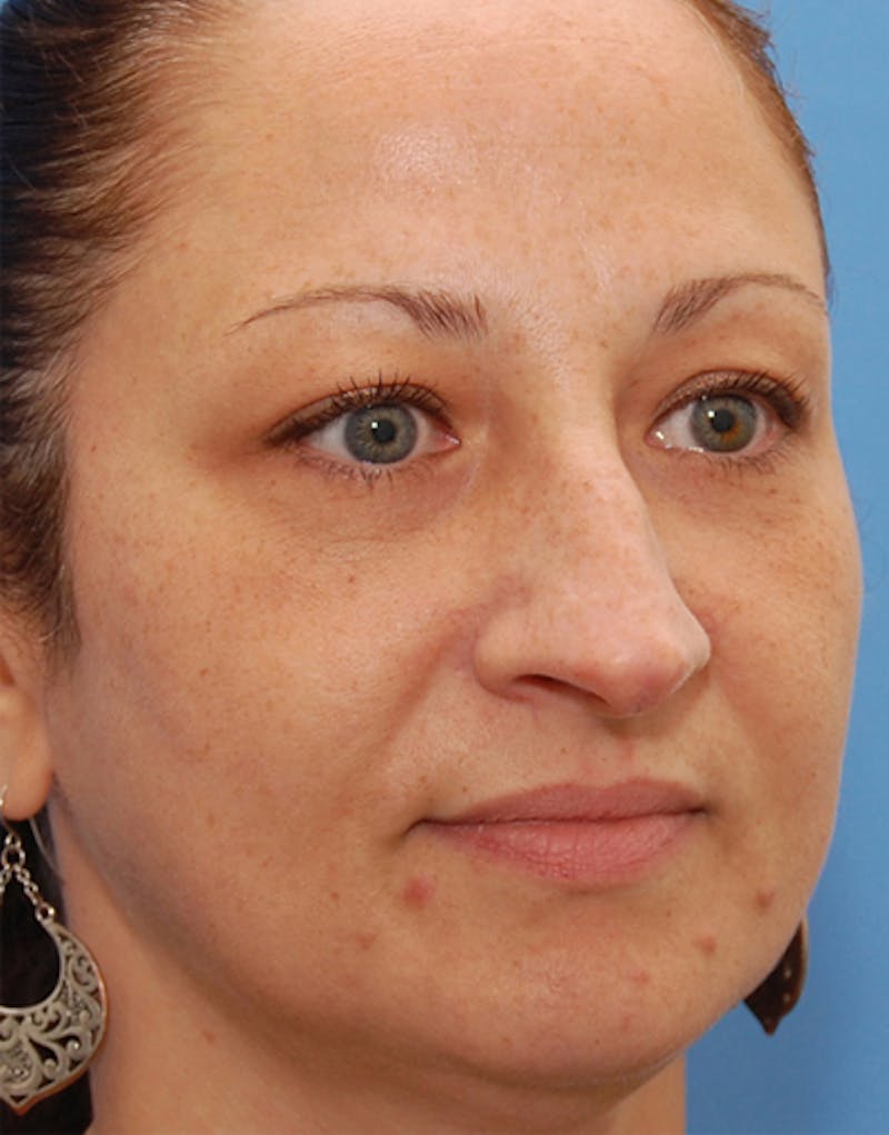 Rhinoplasty Before & After Gallery - Patient 133322 - Image 3