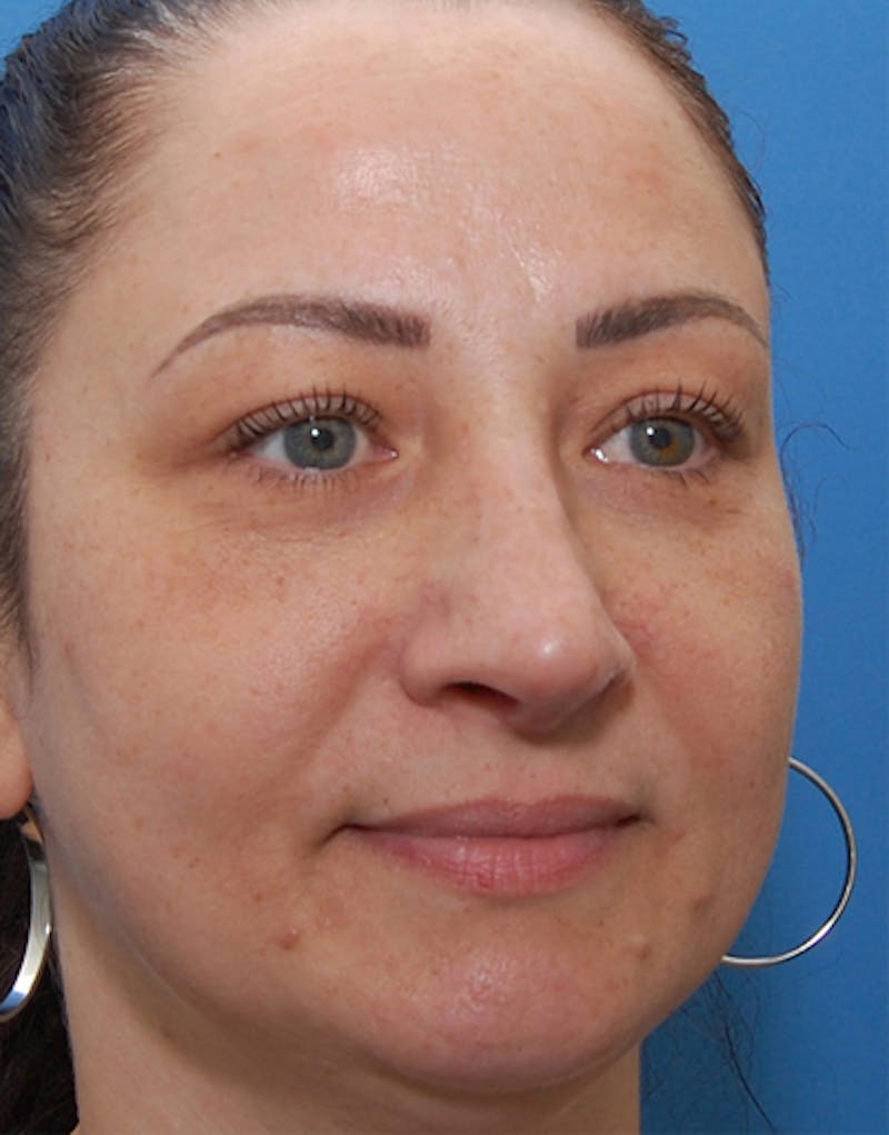 Rhinoplasty Before & After Gallery - Patient 133322 - Image 4