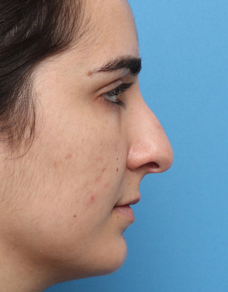 Rhinoplasty Before & After Gallery - Patient 427921 - Image 1