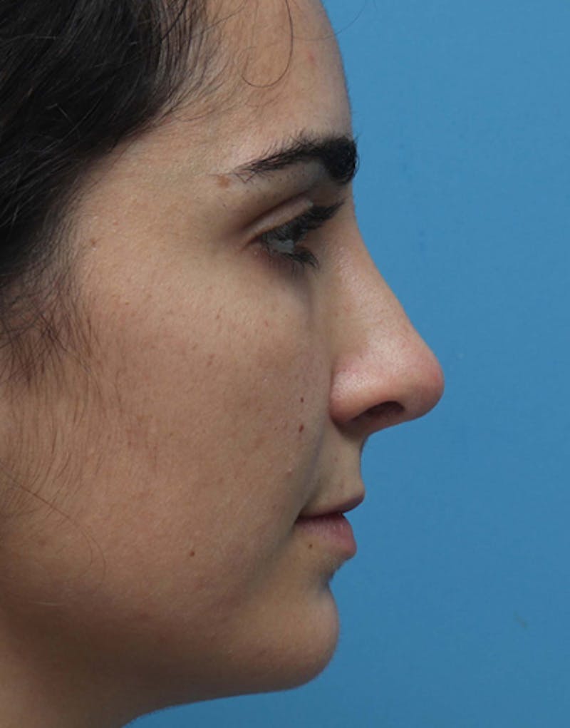 Rhinoplasty Before & After Gallery - Patient 427921 - Image 2