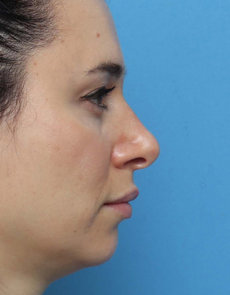 Patient RMz2X-O5QxGTHAcfgZFyqg - Rhinoplasty Before & After Photos