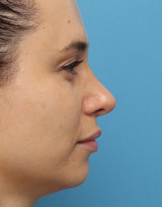 Rhinoplasty Before & After Gallery - Patient 328132 - Image 2