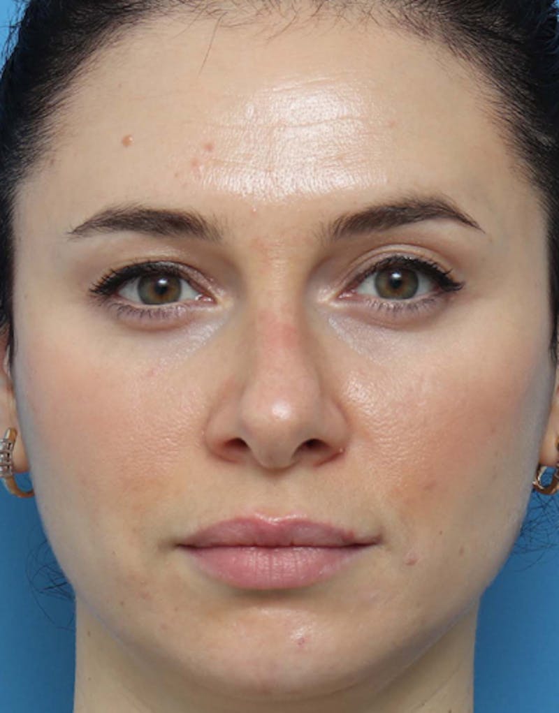 Rhinoplasty  Before & After Gallery - Patient 328132 - Image 3