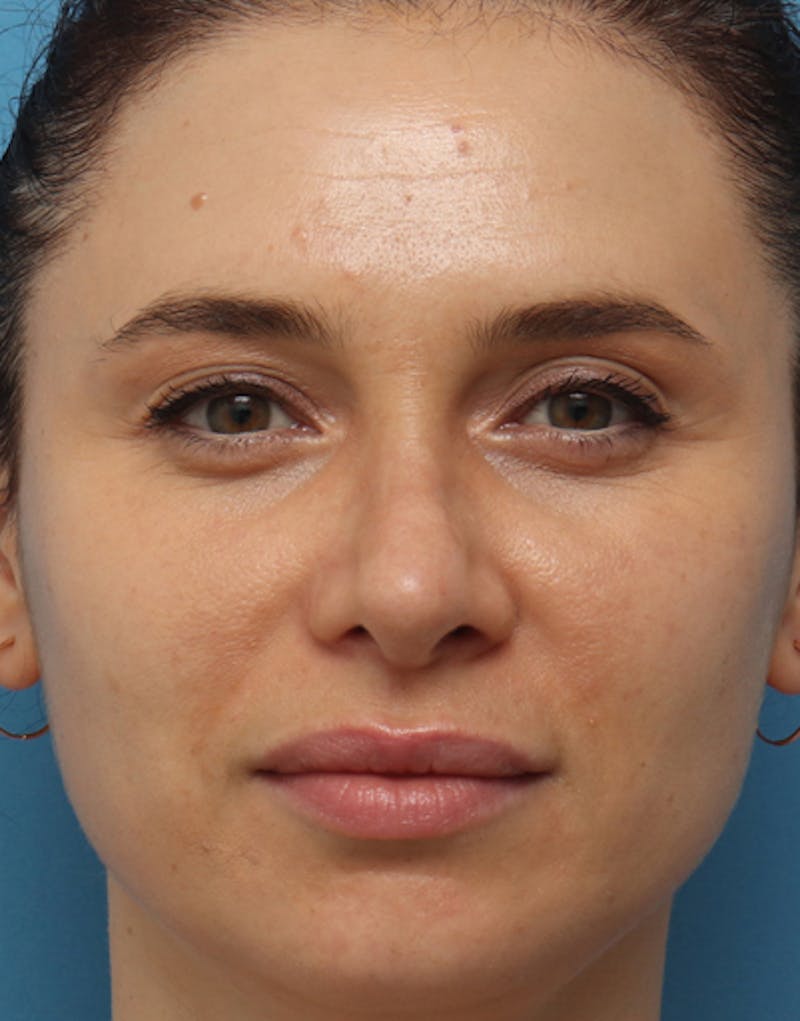 Rhinoplasty Before & After Gallery - Patient 155830 - Image 4
