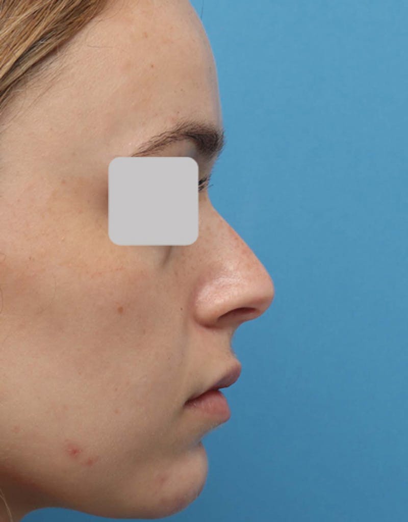 Rhinoplasty Before & After Gallery - Patient 128389 - Image 1