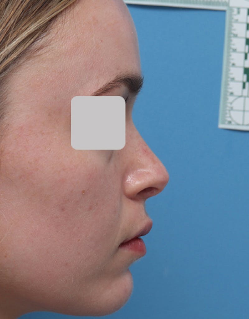 Rhinoplasty Before & After Gallery - Patient 128389 - Image 2