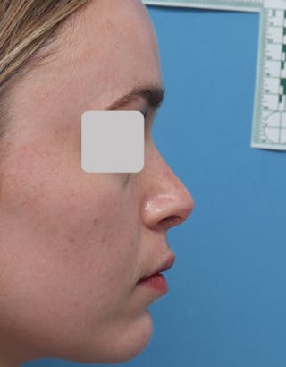 Rhinoplasty Before & After Gallery - Patient 200363 - Image 2