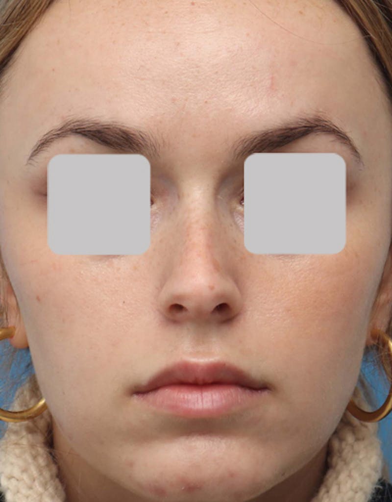 Rhinoplasty  Before & After Gallery - Patient 200363 - Image 3