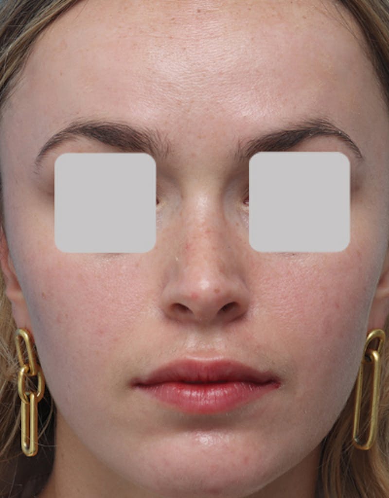 Rhinoplasty  Before & After Gallery - Patient 200363 - Image 4