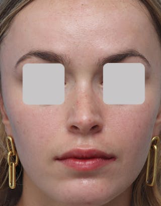 Rhinoplasty Before & After Gallery - Patient 200363 - Image 4