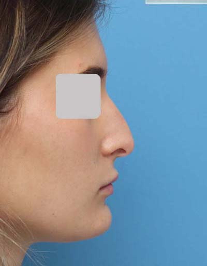 Rhinoplasty Before & After Gallery - Patient 109985 - Image 1