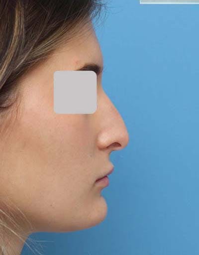 Rhinoplasty Before & After Gallery - Patient 299750 - Image 1
