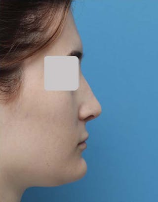 Rhinoplasty Before & After Gallery - Patient 299750 - Image 2