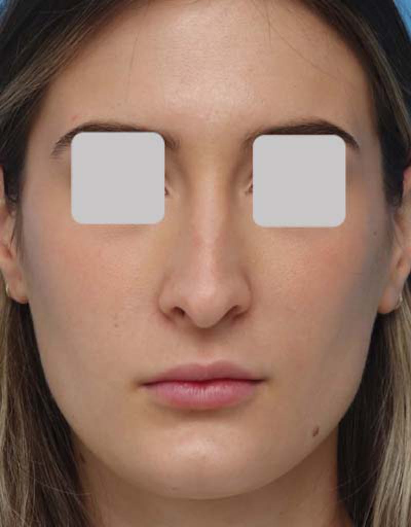 Rhinoplasty  Before & After Gallery - Patient 299750 - Image 3