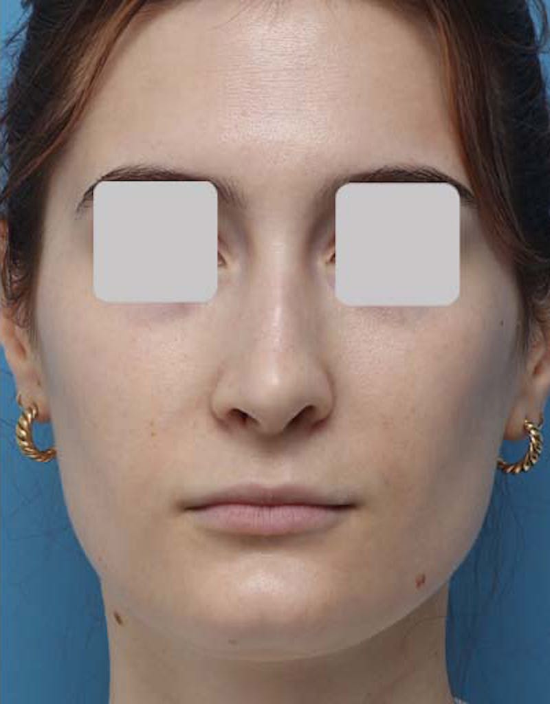 Rhinoplasty Before & After Gallery - Patient 109985 - Image 4