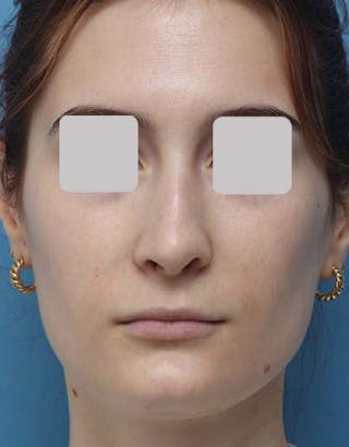Rhinoplasty Before & After Gallery - Patient 299750 - Image 4