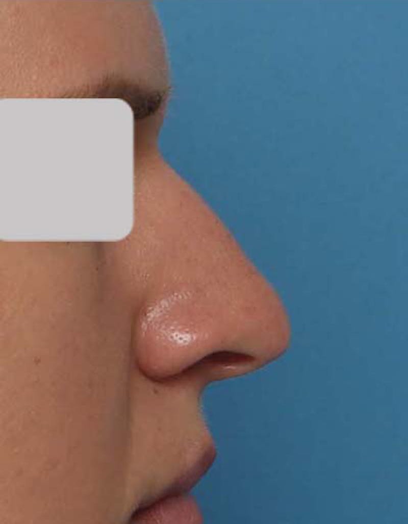 Rhinoplasty Before & After Gallery - Patient 212912 - Image 1