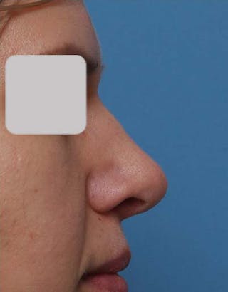 Rhinoplasty Before & After Gallery - Patient 292562 - Image 2