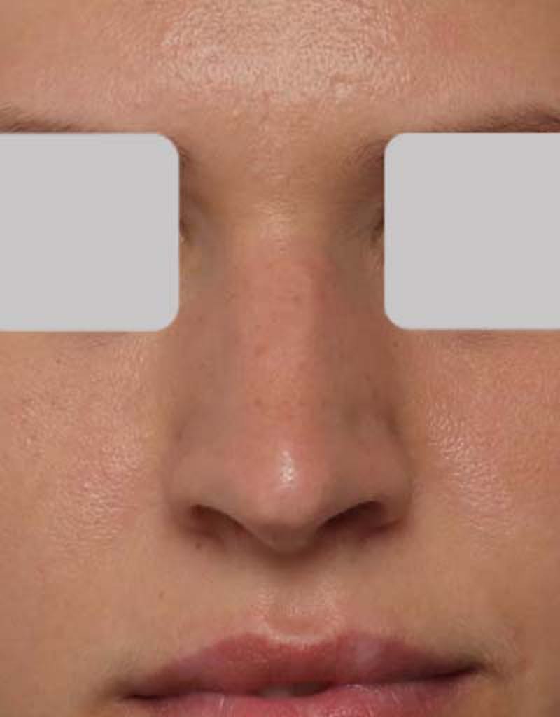 Rhinoplasty Before & After Gallery - Patient 212912 - Image 3