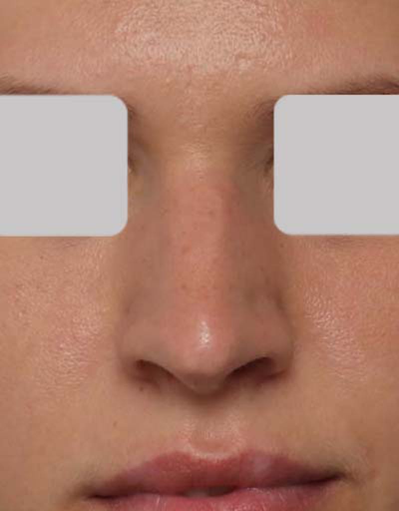 Rhinoplasty  Before & After Gallery - Patient 292562 - Image 3