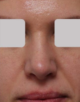Rhinoplasty Before & After Gallery - Patient 292562 - Image 4