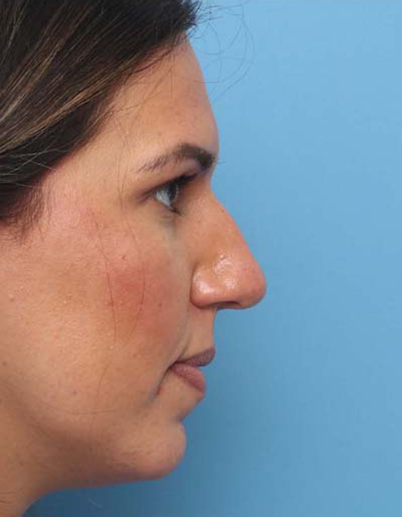 Rhinoplasty Before & After Gallery - Patient 375897 - Image 1