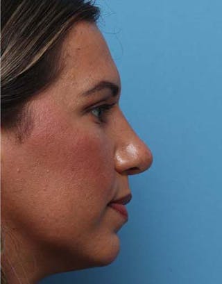 Rhinoplasty Before & After Gallery - Patient 311922 - Image 2