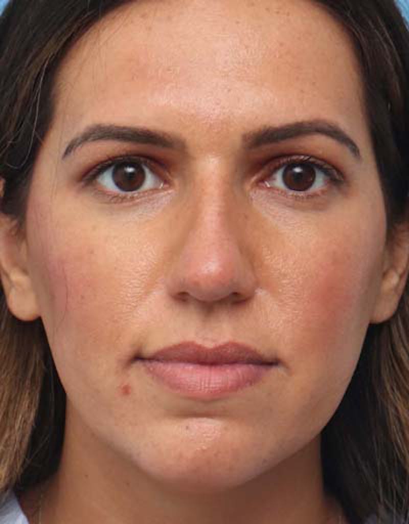 Rhinoplasty Before & After Gallery - Patient 375897 - Image 3