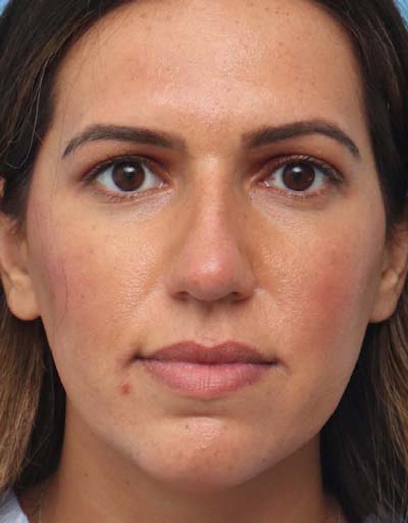 Rhinoplasty  Before & After Gallery - Patient 311922 - Image 3