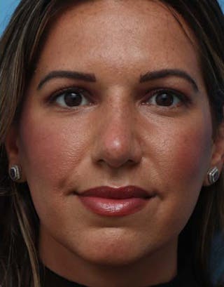 Rhinoplasty Before & After Gallery - Patient 311922 - Image 4