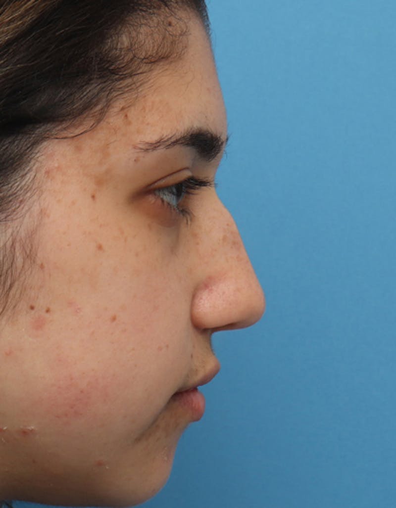 Rhinoplasty Before & After Gallery - Patient 204242 - Image 1