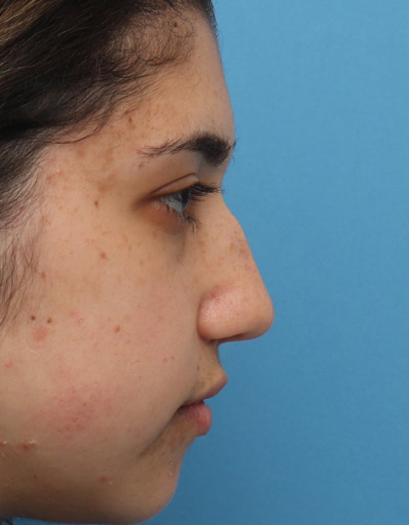 Patient bdc7YWXIRr-aeuwtVC4Y7g - Rhinoplasty Before & After Photos