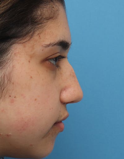 Rhinoplasty Before & After Gallery - Patient 391687 - Image 1